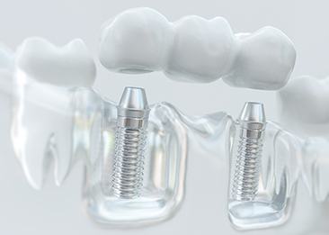 implant bridge being put on 3D model