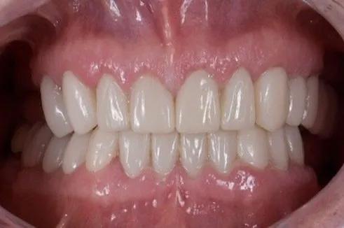 Close up of mouth with flawless teeth after treatment from Downers Grove dentists