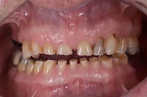 Close up of gapped discolored teeth before dental treatment