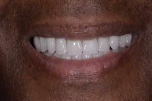 Close up of smile with flawless teeth