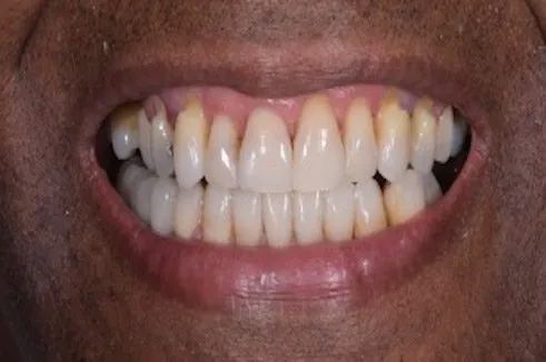 Close up of long and slightly yellowed teeth