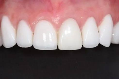 Close up of row of bright white teeth