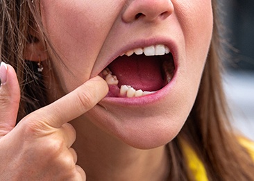 Woman missing a tooth