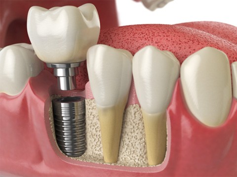 : a graphic illustration of an implant crown