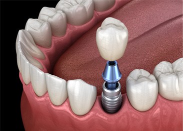 a graphic illustration of an implant crown