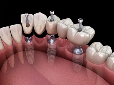 a graphic illustration of an implant bridge