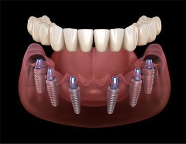 a graphic illustration of an implant denture