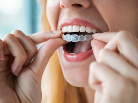 Close up of person placing Invisalign aligner over their teeth