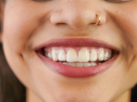 Close up of smiling person wearing Invisalign aligner