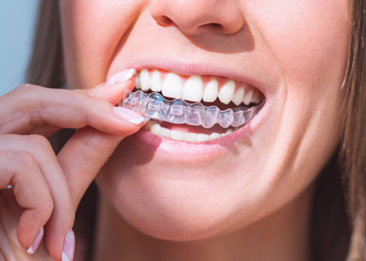 Female holding her Invisalign aligner in preparation for putting it in 