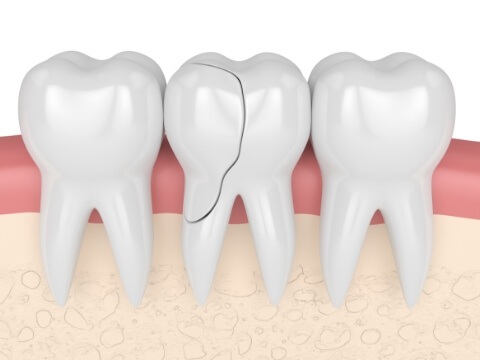 Illustrated row of teeth with one cracked