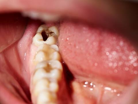 Close up of mouth with one broken tooth